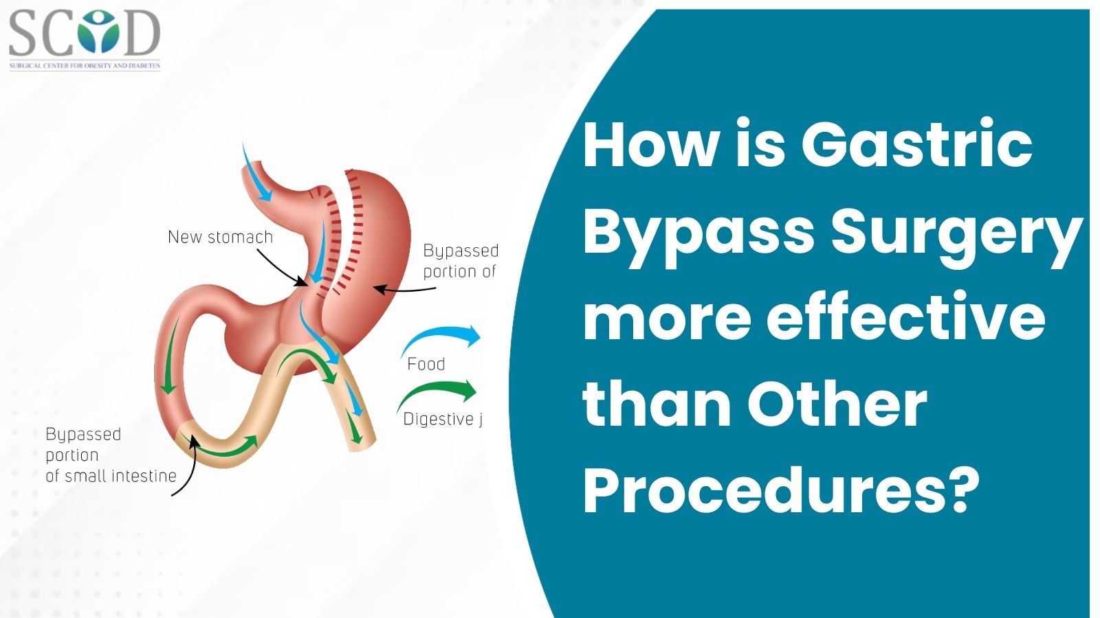 How is Gastric Bypass Surgery more effective than Other Procedures?
