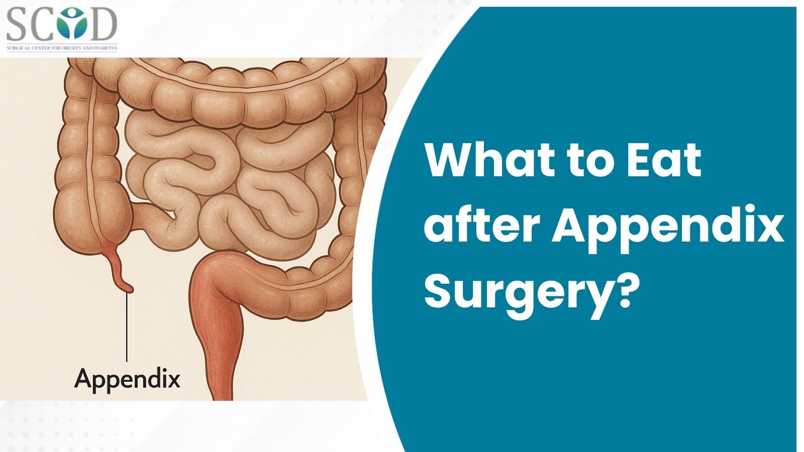 What to Eat after Appendix Surgery?