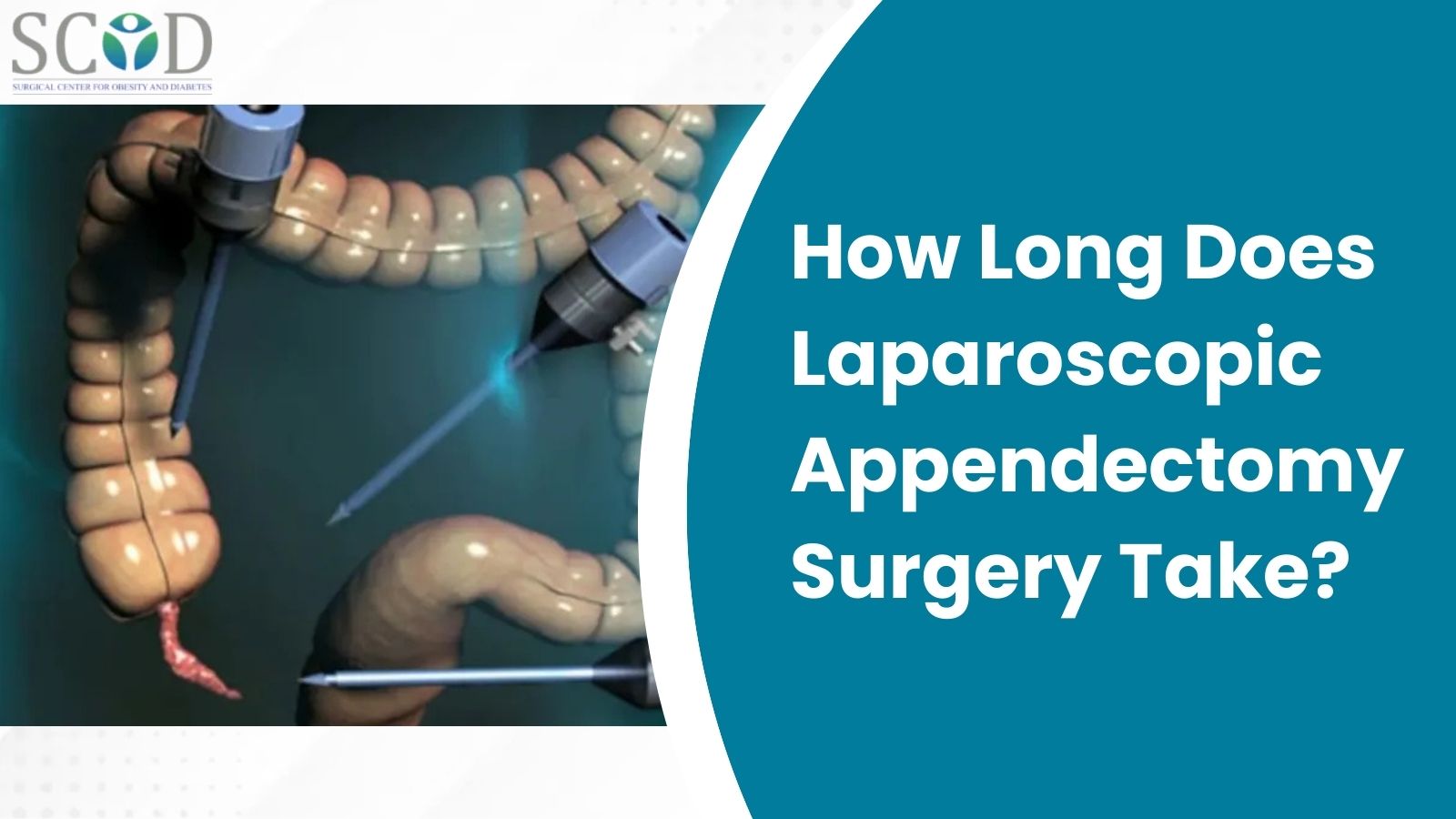 how long does laparoscopic appendectomy surgery take