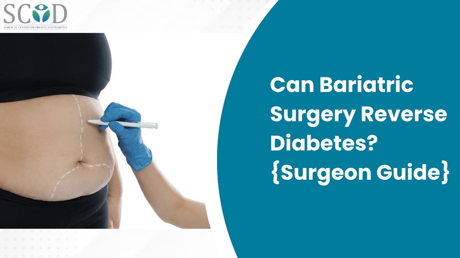 Can Bariatric Surgery Reverse Diabetes