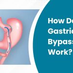 How Does Gastric Bypass Work