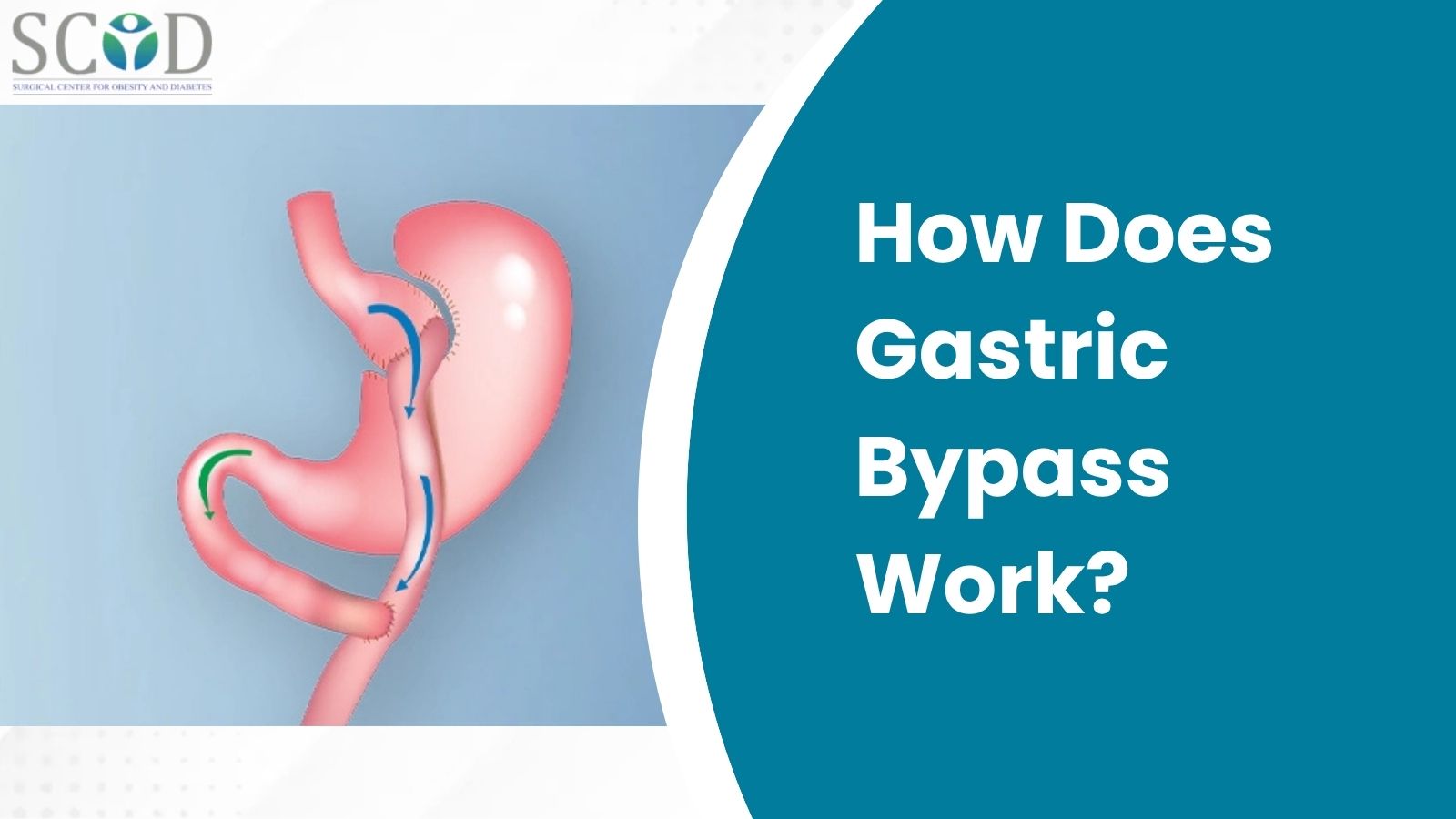 How Does Gastric Bypass Work
