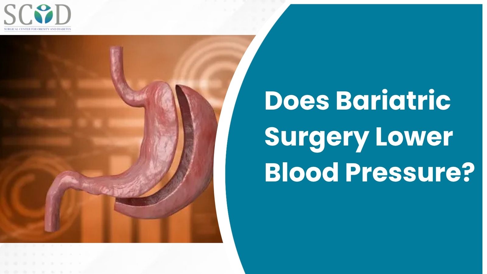 Does Bariatric Surgery Lower Blood Pressure